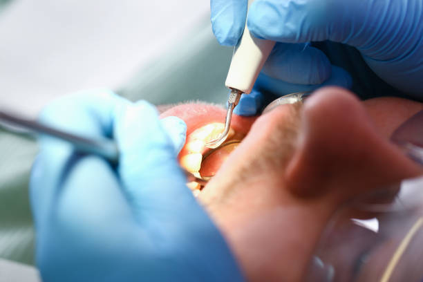 Best Emergency Treatment for Dental Infections or Abscesses in Olivet, TN